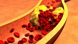 고지혈증이란 고지혈증 증상과 원인, 좋은 음식 8가지