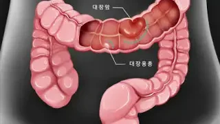 대장암의 증상과 원인, 치료법의 종류