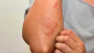 아토피 피부염의 증상과 원인, 치료방법 및 예방법은