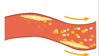 콜레스테롤이 높으면 생기는 증상, 낮추는 방법, 낮추는 음식