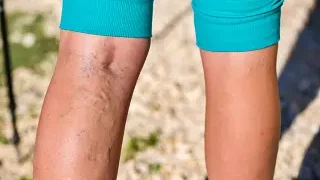 하지정맥류의 증상 및 원인, 종류 및 치료법은