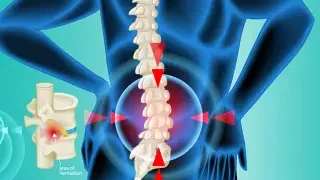 허리디스크의 증상과 원인, 통증 예방법은